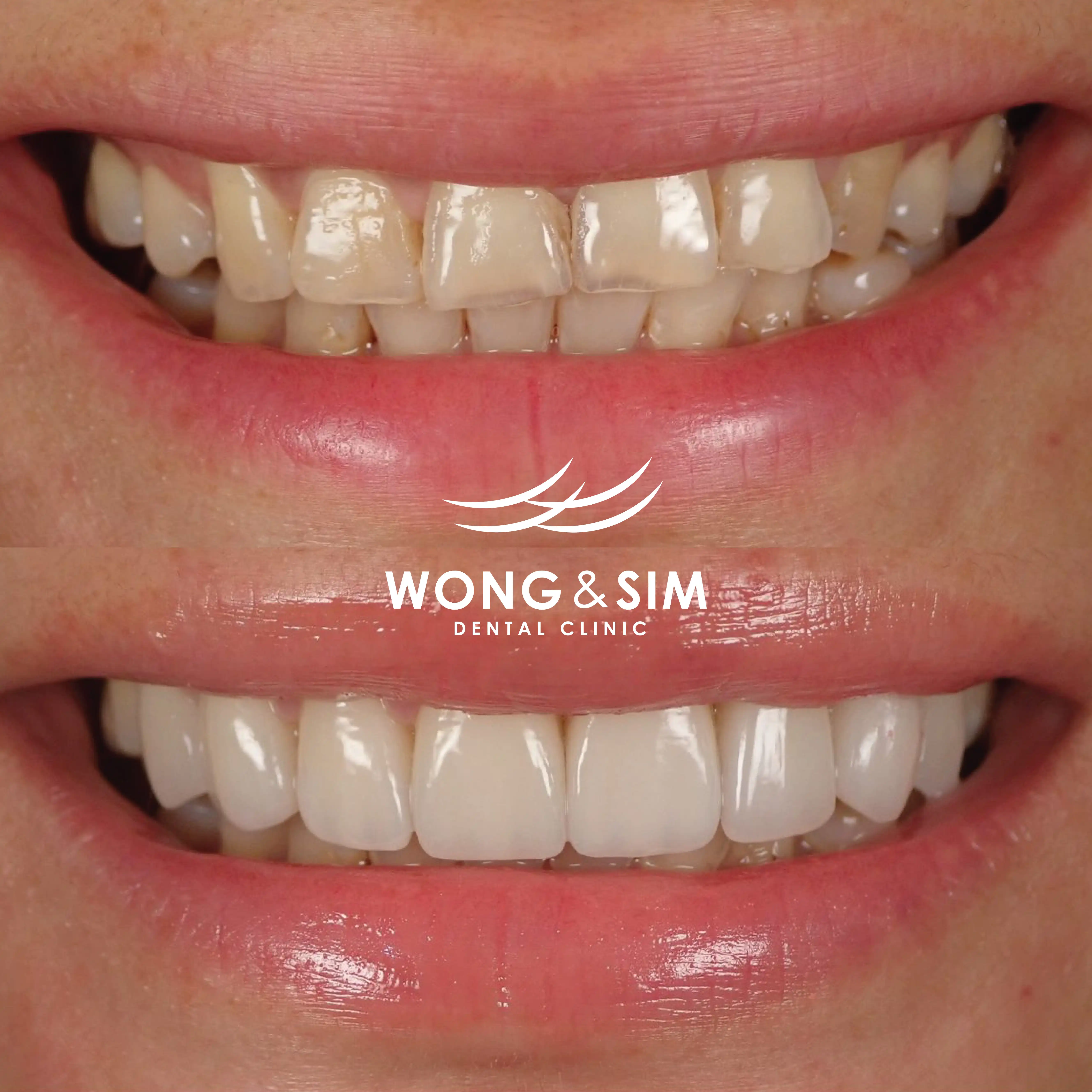 Patient 5 - Smile Makeover Before and After